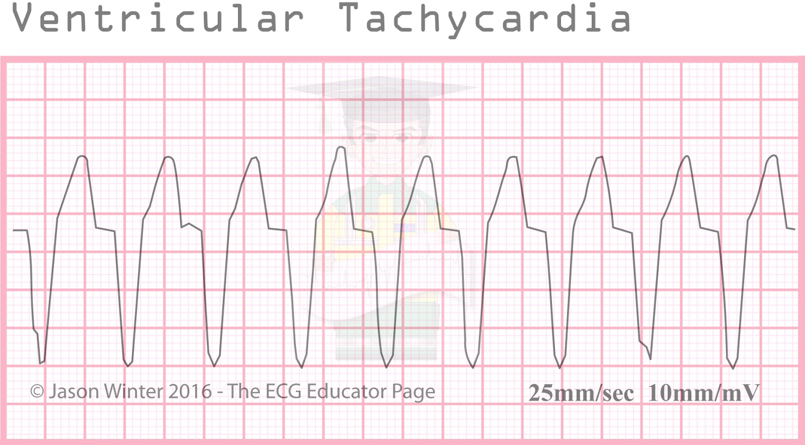 ecg-educator-blog-ventricular-rhythms