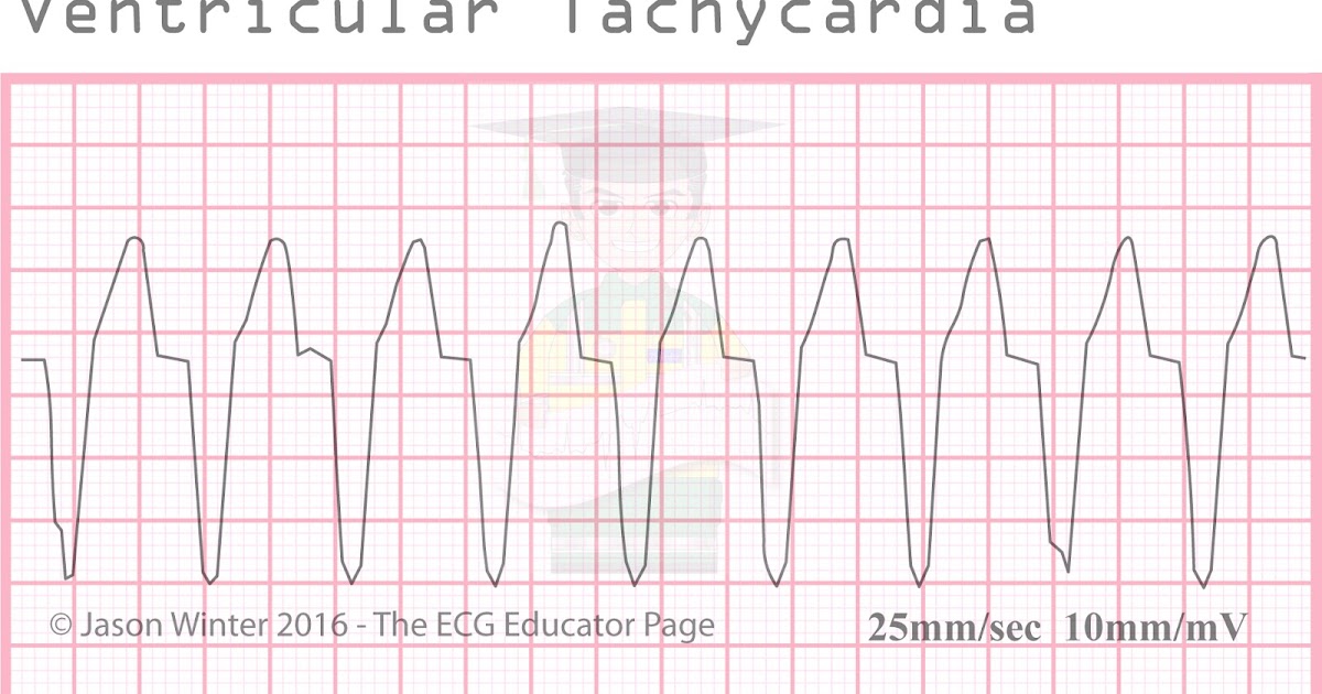 Ekg Strips Flashcards EKG dysrhythmias StudyBlue amandaazer