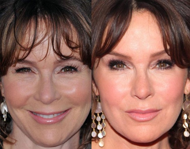 Jennifer Grey Nose Job Before and After | Celebrity Bad Plastics Surgery