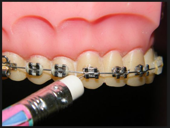 Брекеты сколько будет болеть