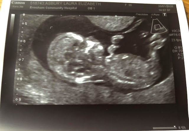 12 Weeks Pregnant - NT Baby (Cystic Hygroma Happy Ending)