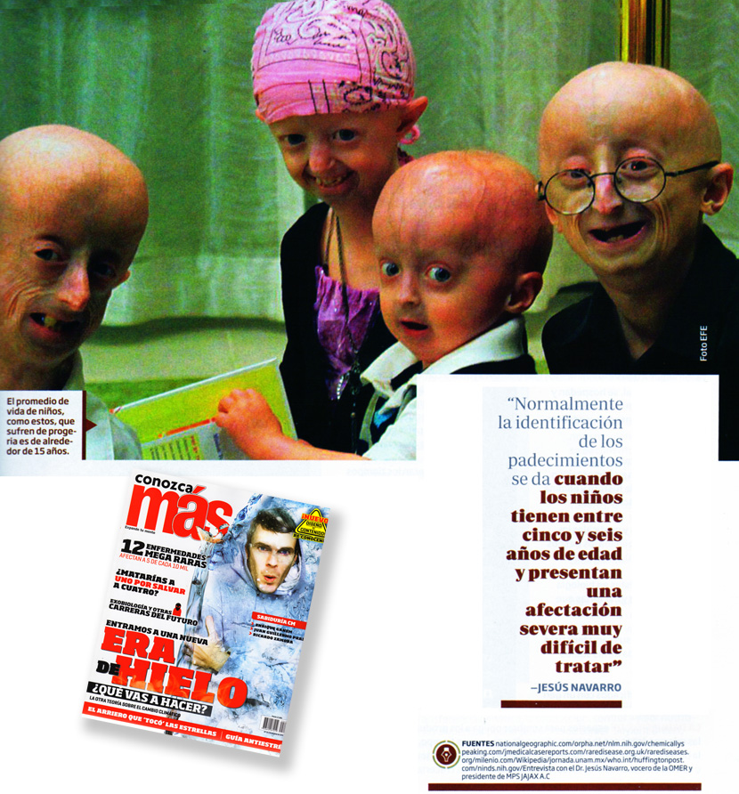 04-progeria.jpg