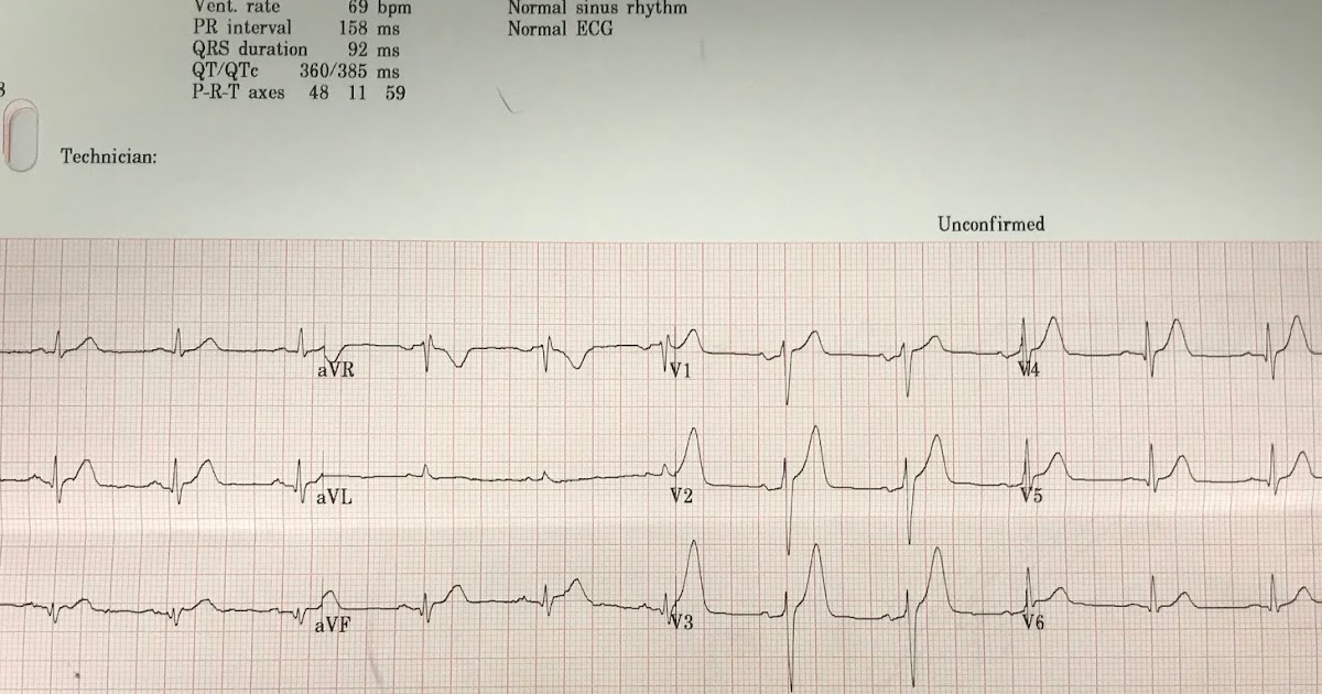 Dr. Smith's ECG Blog Acute Chest pain in a 50something, and a "Normal