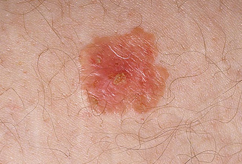Pictures Of Skin Cancer Skin Cancer Early Signs 