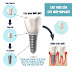 Làm răng implant cho răng cửa