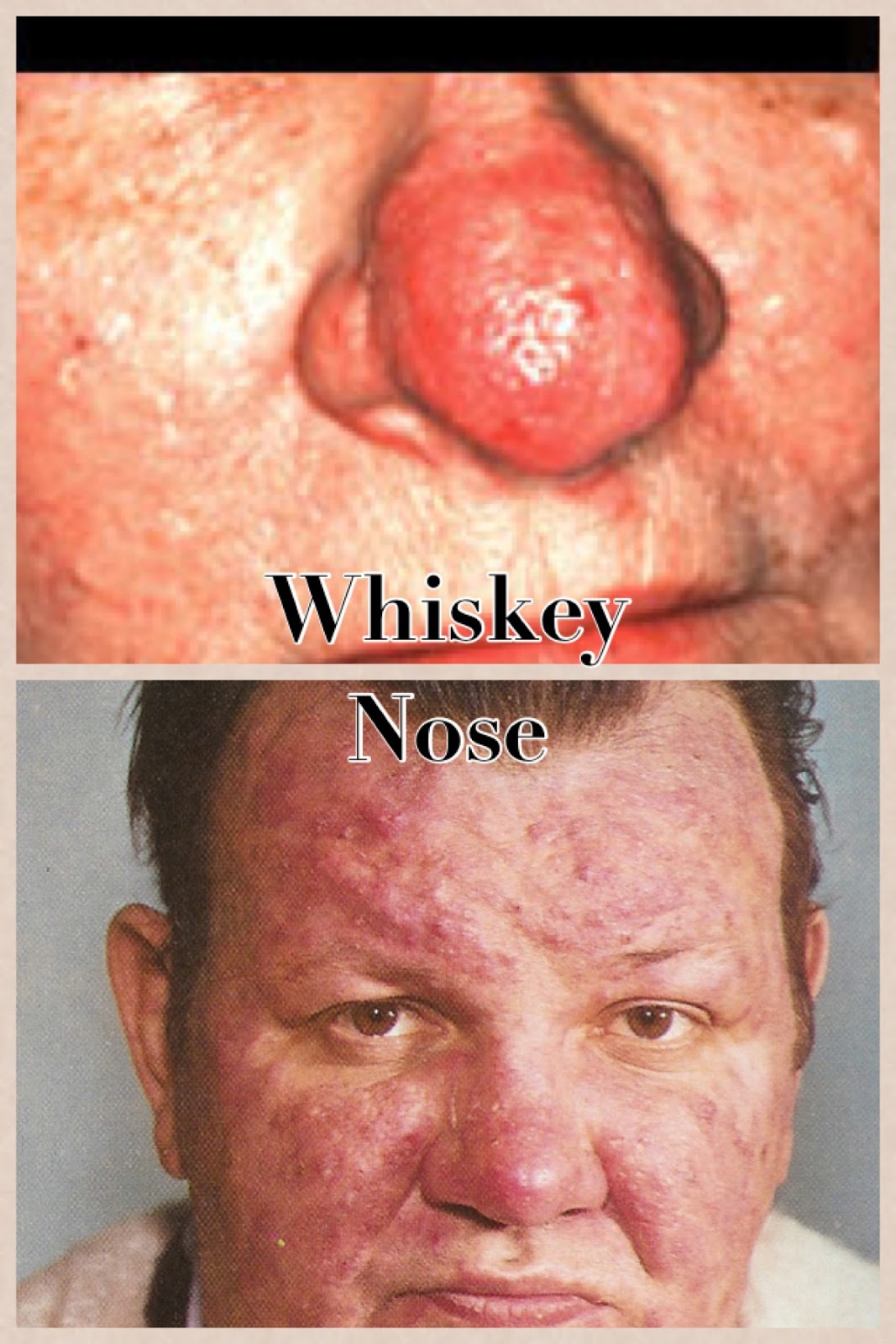 Cutaneous adverse effects of alcohol | DermNet New Zealand