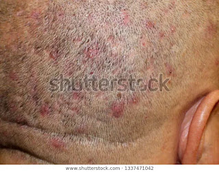 Scalp Folliculitis Treatment Scalp Folliculitis Treatment