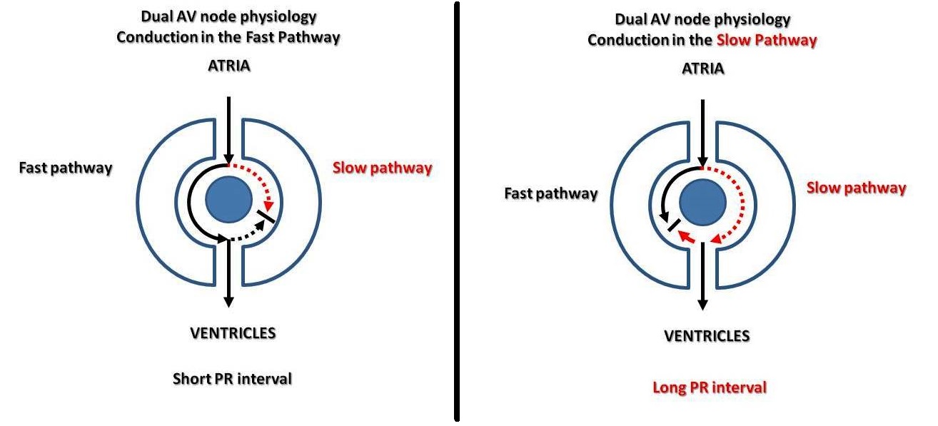 ECG Rhythms A reentry phenomenon