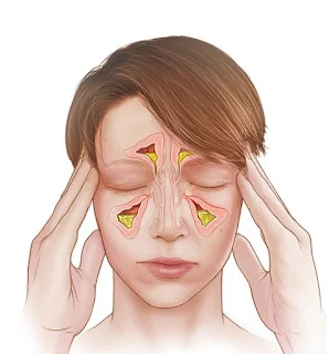 Physiotherapy In Sinusitis  Treatment