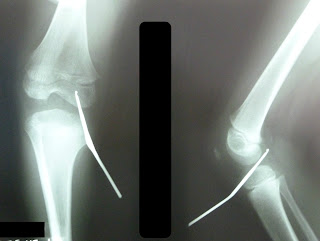 Revision Casos De Cirugia General: LESION PENETRANTE ACCIDENTAL POR ...