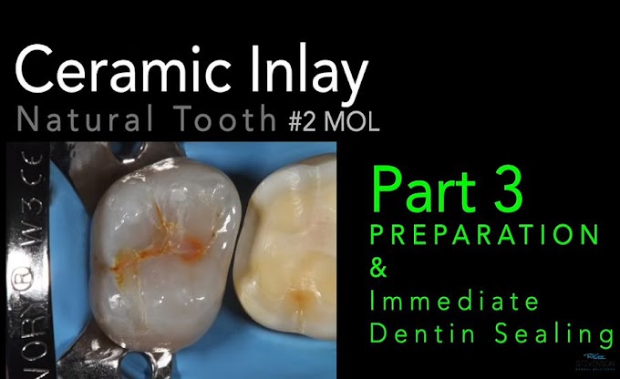 CLINICAL CASE: Ceramic Inlay, Part 3 (Preparation and IDS)
