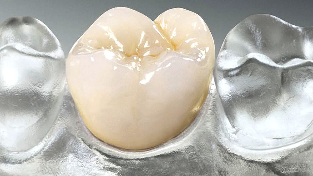 Advantages of All Ceramic crowns Directorio Odontológico