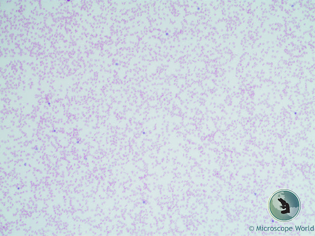 Microscope World image of sickle cell anemia under the microscope at 100x.