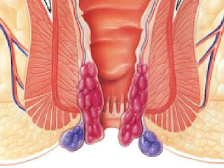 jual obat untuk penyakit wasir di jawa timur, cara mengobati ambeien saat hamil, jual obat untuk mengobati wasir di pulau taliabu, obat ambeien atau wasir yang ampuh dan aman, cara mengatasi rasa sakit ambeien atau wasir,  wasir bengkak, khasiat obat penyakit ambeien ambeien, obat untuk mengobati wasir menurut dokter, pengobatan untuk ambeyen, cara mengatasi ambeien atau wasir pada ibu menyusui, ambeien adalah penyakit keturunan, obat untuk penyakit wasir paling mujarab, obat penyakit ambeien herbal yang mujarab, mengobati ambeien cara herbal, obat ambeien atau wasir di apotik bebas, obat buat penyakit ambeien cabe rawit, obat alami menghilangkan benjolan wasir atau ambeien, efek obat wasir, obat rendam ambeyen, jual obat ambeien di kepahiang, obat buat penyakit ambeien di tideng pale, obat buat penyakit ambeien buat ibu menyusui, obat buat penyakit wasir tradisional mujarab, obat penyakit ambeyen de nature, cara mengobati penyakit wasir stadium 3 secara alami, cara mengatasi ambeyen yang sudah keluar, cara mengobati ambeyen stadium 1, jual obat buat penyakit ambeien di dolok marawa, obat penyakit wasir kulit manggis, mengobati nyeri ambeyen