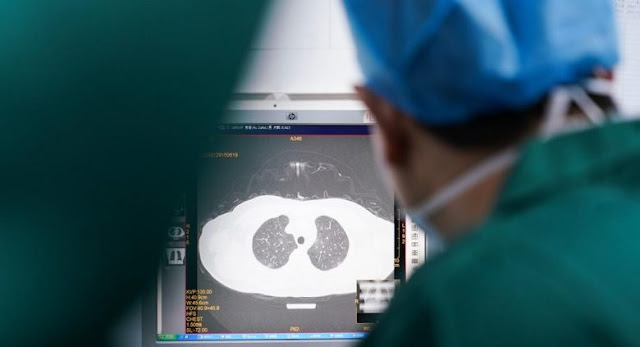 Covid lungo che distrugge i polmoni, i danni ai pazienti possono essere grandi
