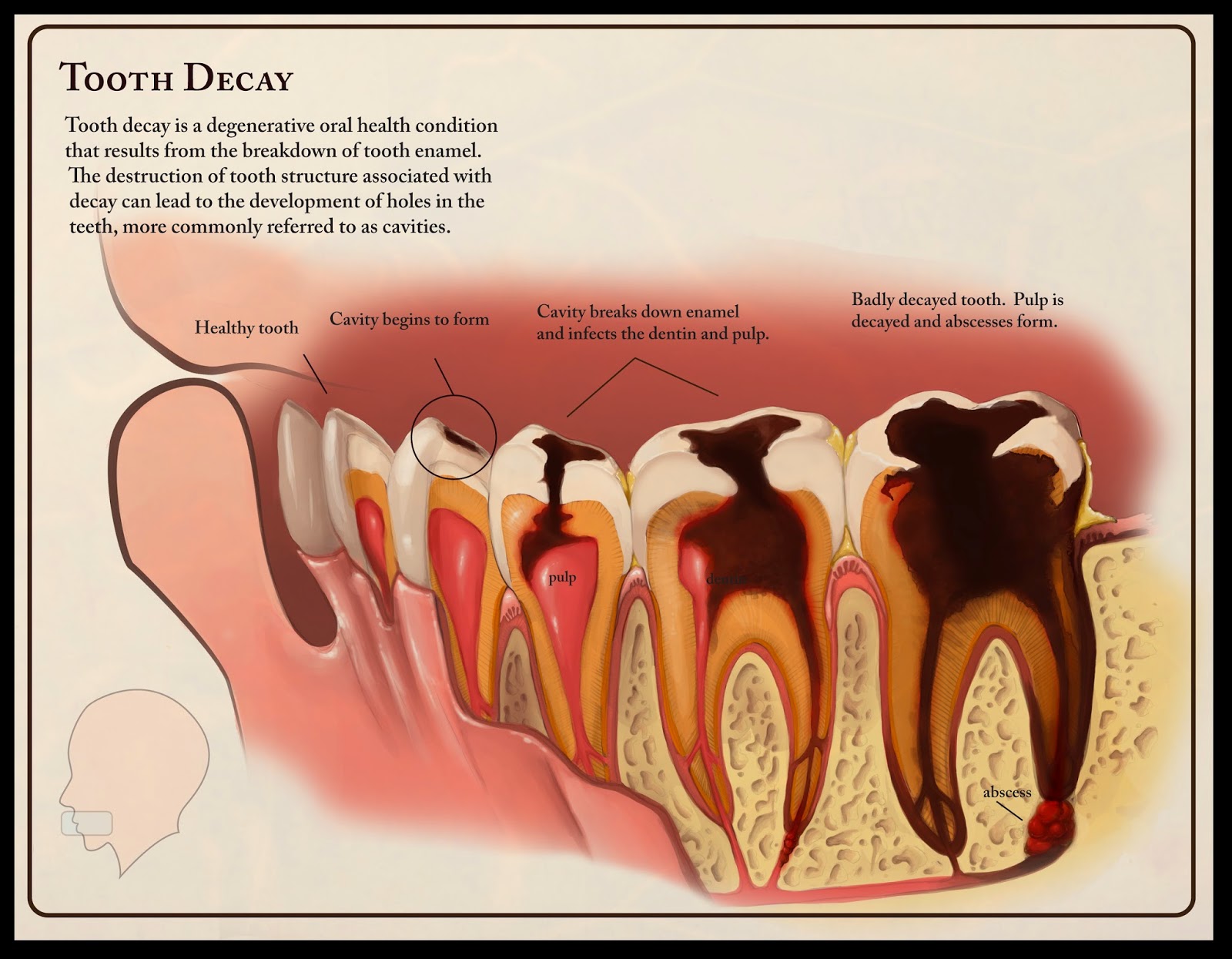 Medical Sundries Tooth Decay