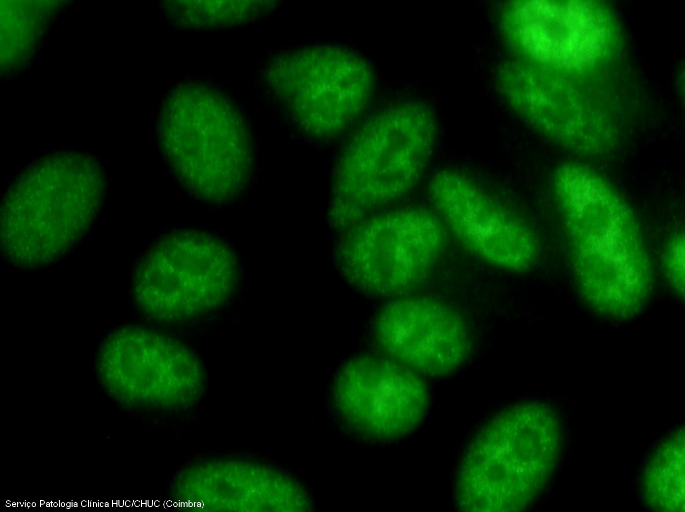 Anticorpos anti SSA (Ro) e anti
