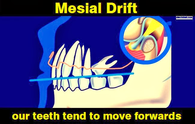 MESIAL DRIFT: Our teeth tend to move forwards