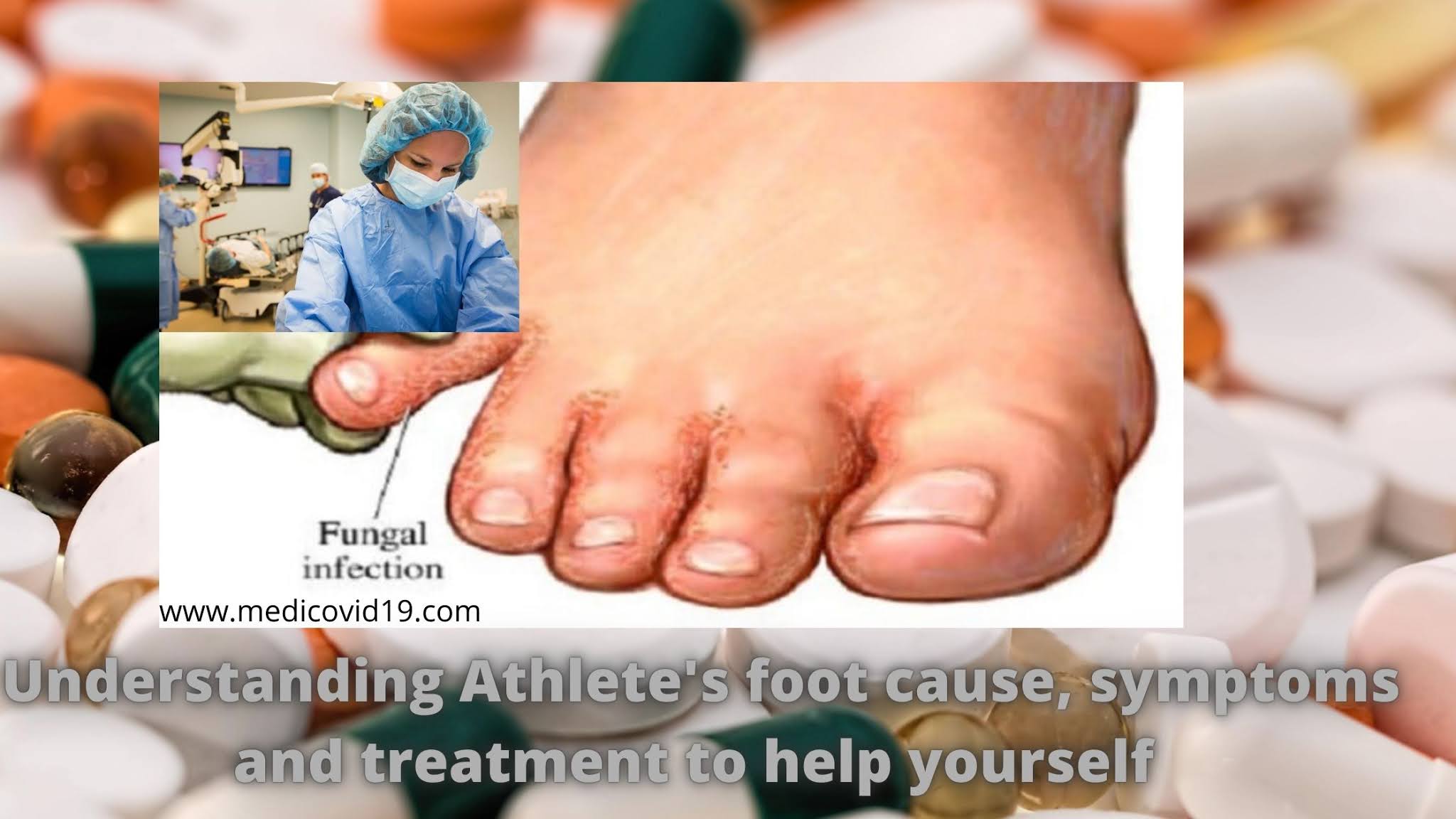 Understanding Athlete's foot cause, symptoms and treatment to help yourself