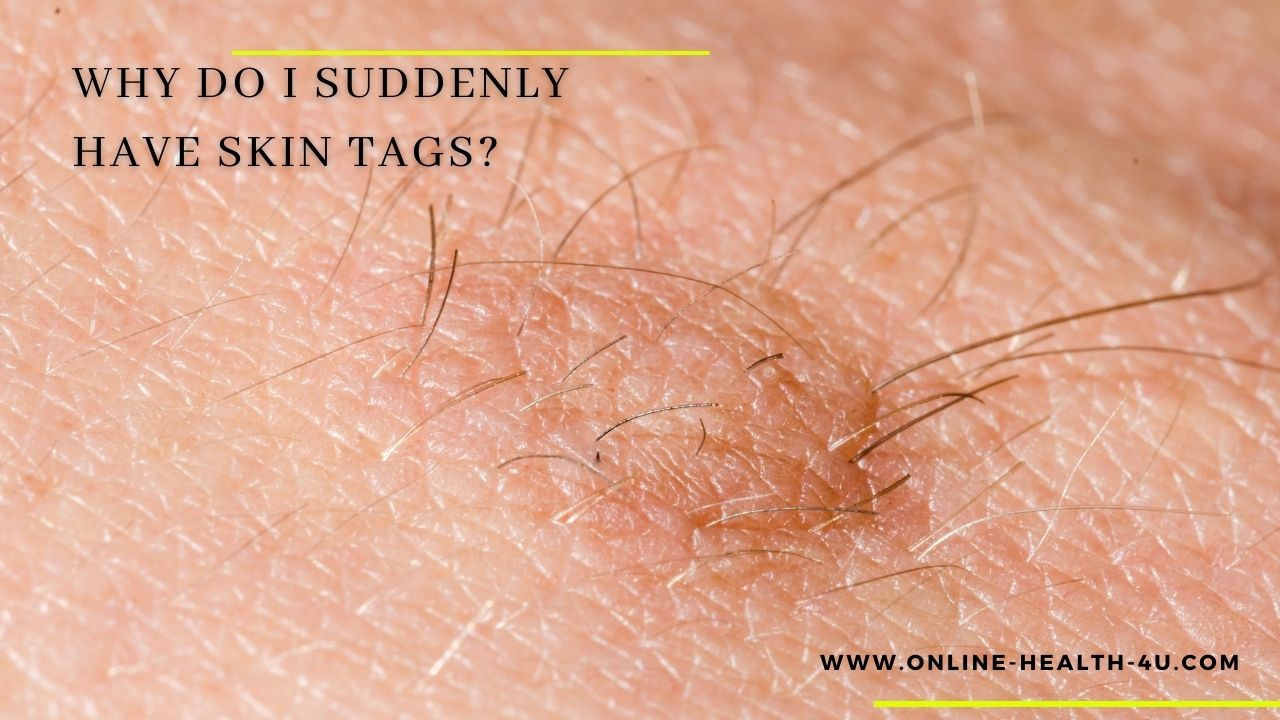 Skin-Tags-causes-symptoms-on-neck-treatment-2021
