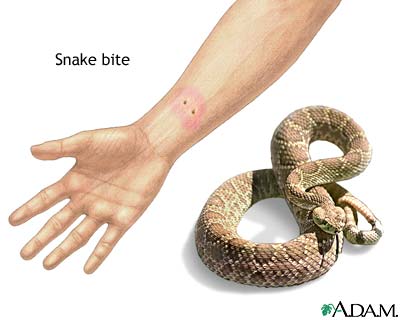 askep snake bite