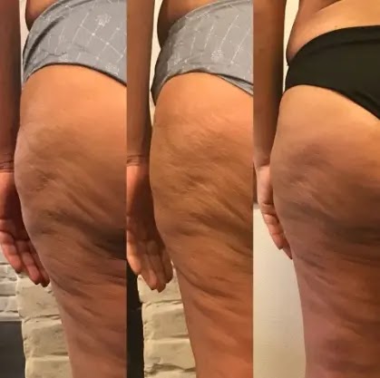 anti celluite, At War With Celluite anti celluite, At War With Celluite
