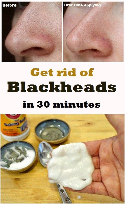 How To Get Rid Of Blackheads On Nose Cheeks And Chin How To Get Rid Of Blackheads On Nose Cheeks And Chin