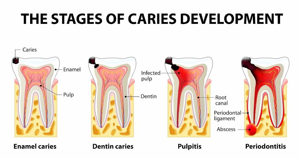 Dentosphere World of Dentistry What is Root Canal Treatment (RCT)? Why do I need to Do RCT?