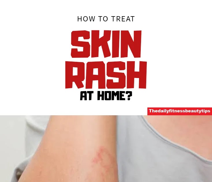 How To Treat Heat Rash?
