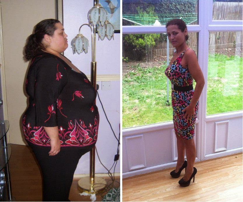 Revision Weight Loss Surgery Weight Loss Options For Morbidly Obese revision-weight-loss-surgery-weight-loss-options-for-morbidly-obese