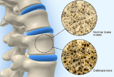 Xương bạn có thể bị loãng hay không Xuong-cua-ban-co-that-su-bi-loang