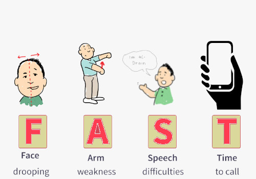  Early Signs of a Stroke