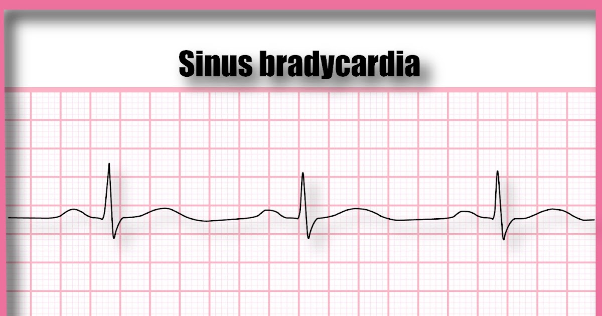ECG Educator Blog Sinus Bradycardia