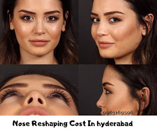 Nose reshaping cost in hyderabad