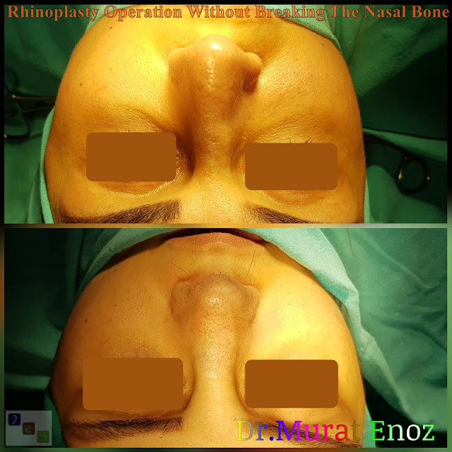 Nose job without bone broken,Rhinoplasty Without Breaking The Nasal Bone in Istanbul,