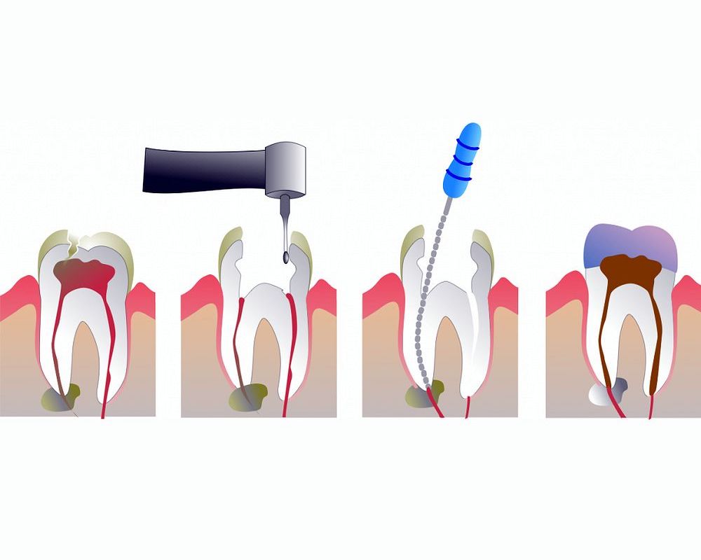 PULPECTOMY procedures in primary molar teeth OdontoVida