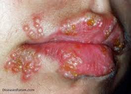penyakit herpes