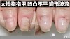 指甲矯正-大拇指凹凸不平、變形波浪，順利矯正到健康的問題指甲處理案例！