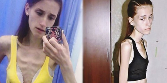 Dulu Badannya Kurus Kering Tak Karuan, Setelah 2 Tahun Kini Para Pria Dibikin Mabuk Kepayang Dulu Badannya Kurus Kering Tak Karuan, Setelah 2 Tahun Kini Para Pria Dibikin Mabuk Kepayang