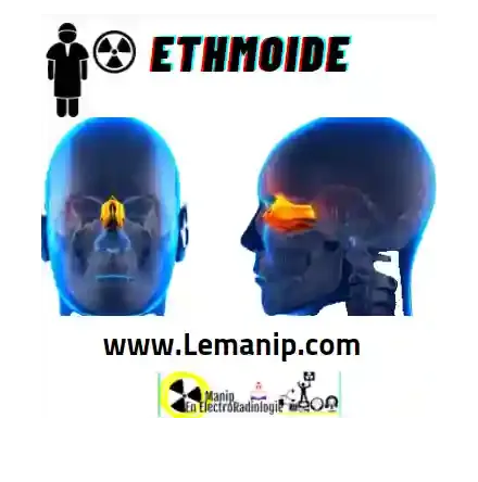 Ethmoïde