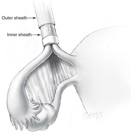 The tube is allowed to retract from the applicator sheath