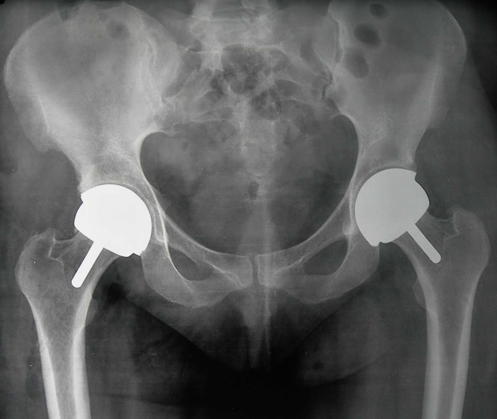 My life is all HIP'S REPLACEMENT OPERATION