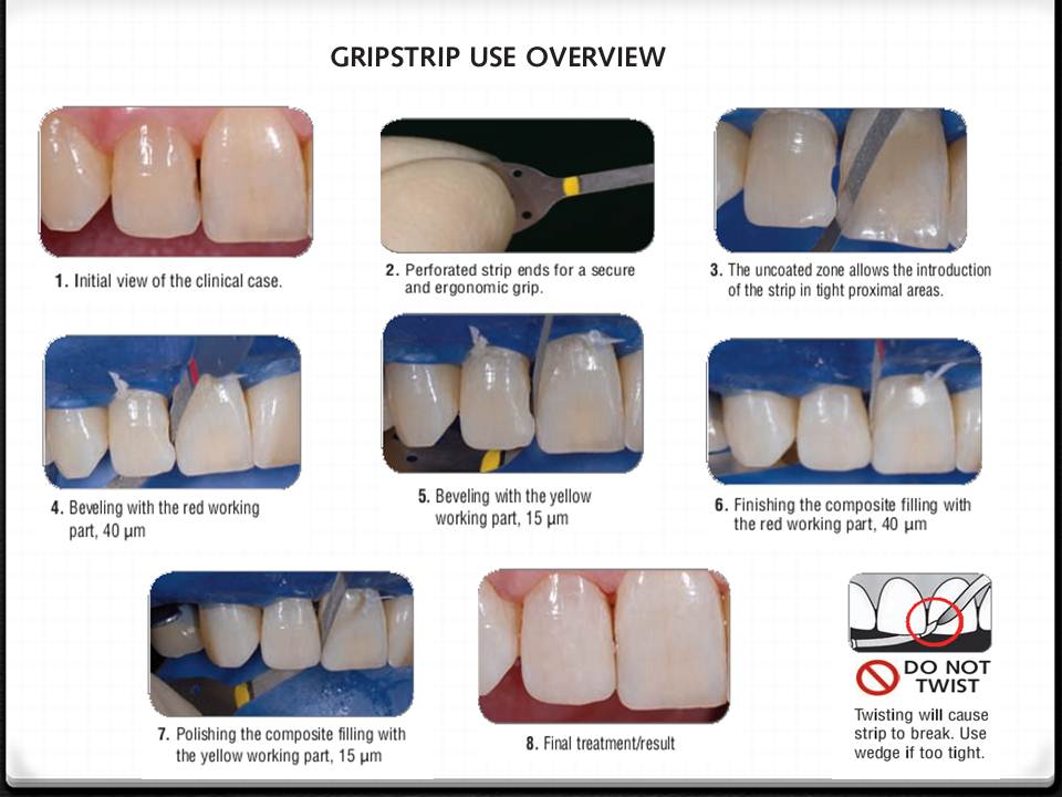 DOs and DONTs in DENTISTRY Polishing Composite Restorations EASY