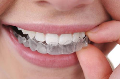 Niềng răng không nhổ răng là gì?