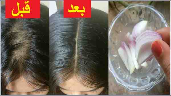 تجربتي مع ماء البصل للشعر