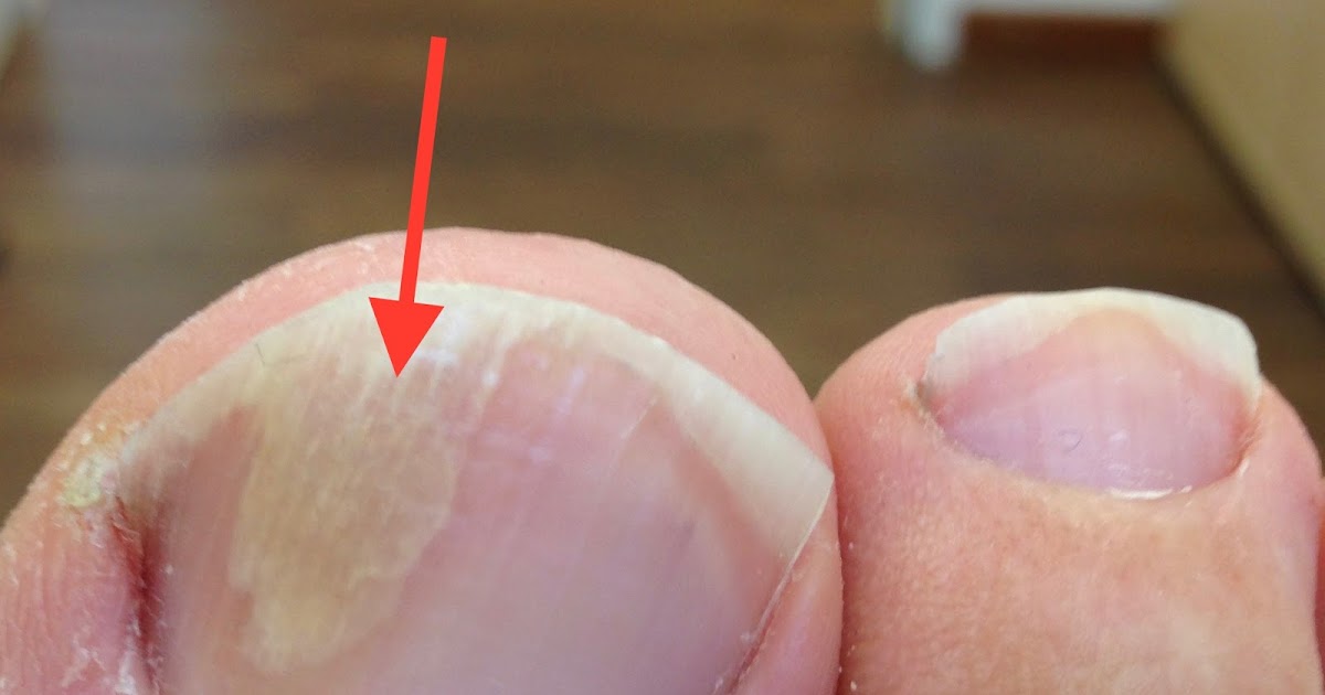 Fußnagel löst sich ab. Jenn Cosmetic. Nagelpilz, harte Fußnägel? Fußnagel Spray/Jenn Cosmetic Fußnagel löst sich ab. Jenn Cosmetic. Nagelpilz, harte Fußnägel? Fußnagel Spray/Jenn Cosmetic