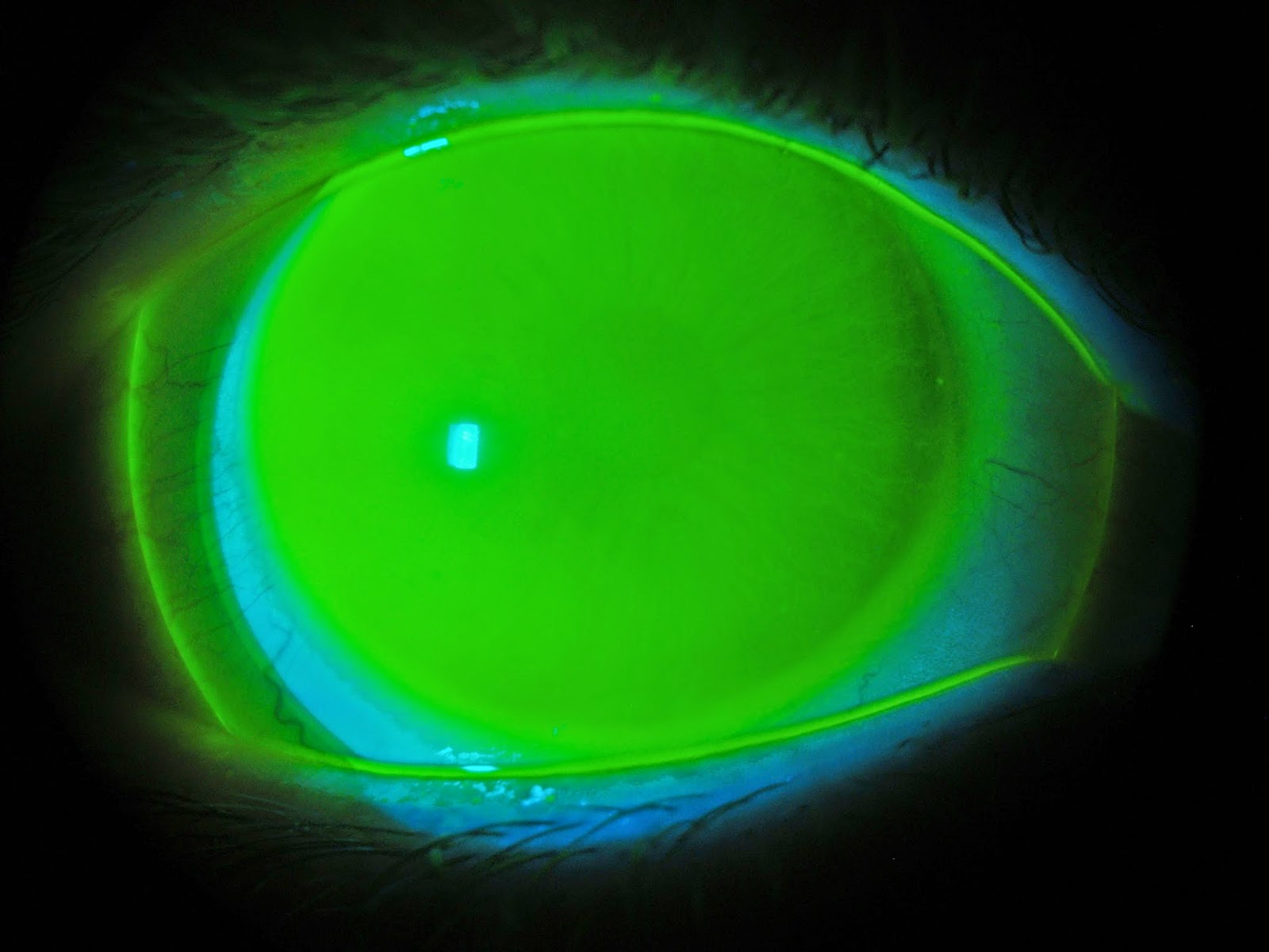 ULTRALENTES: Pre-Release: Lente Escleral SB Reverse e RGP Multifocal