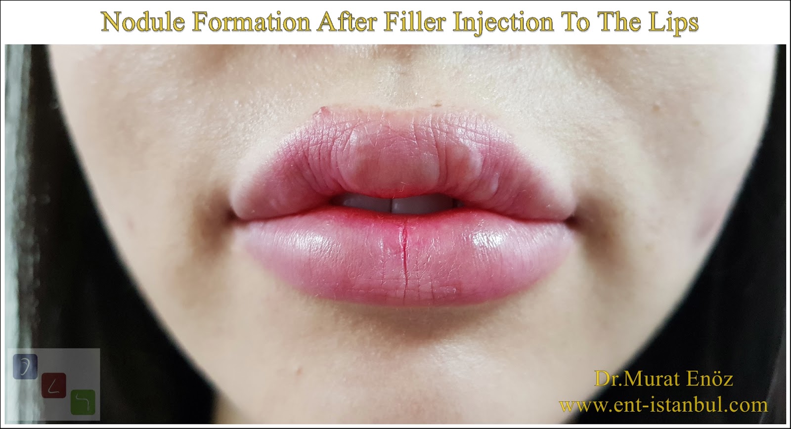 Nodule Formation After Filler Injection To The Lips