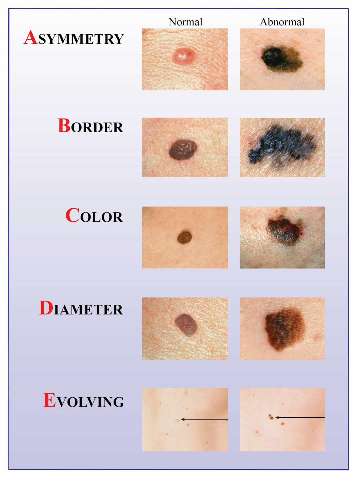 Remember The Abcdes Of Melanoma The Eye Associates