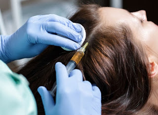 Mesoterapia para combatir la caída del cabello después del embarazo